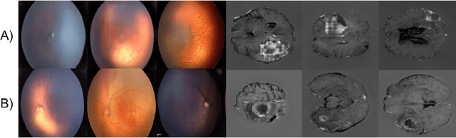 Figure 3 for High-resolution medical image synthesis using progressively grown generative adversarial networks