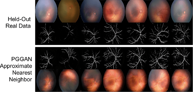 Figure 4 for High-resolution medical image synthesis using progressively grown generative adversarial networks