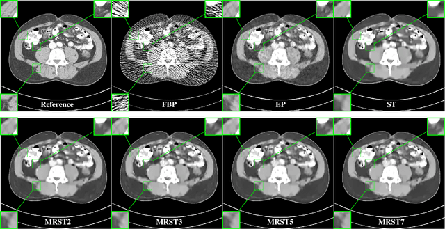 Figure 2 for Learned Multi-layer Residual Sparsifying Transform Model for Low-dose CT Reconstruction
