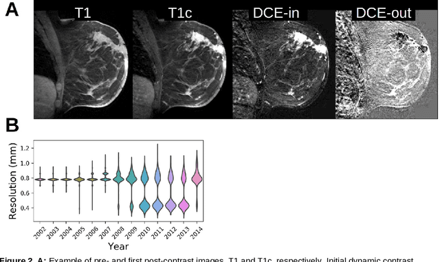 Figure 2 for Deep learning achieves radiologist-level performance of tumor segmentation in breast MRI