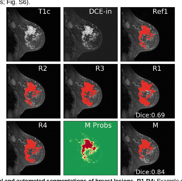 Figure 4 for Deep learning achieves radiologist-level performance of tumor segmentation in breast MRI