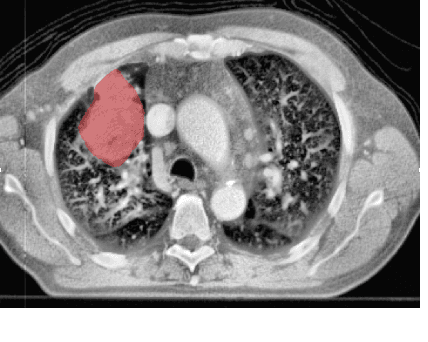 Figure 1 for Image-based Survival Analysis for Lung Cancer Patients using CNNs
