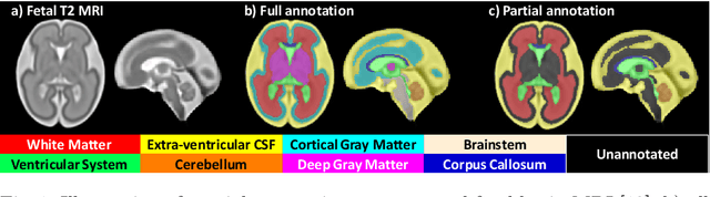 Figure 1 for Label-set Loss Functions for Partial Supervision: Application to Fetal Brain 3D MRI Parcellation