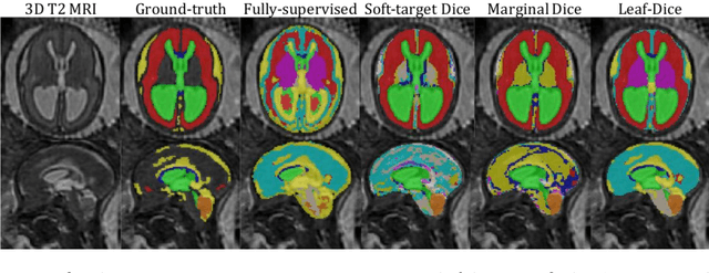 Figure 3 for Label-set Loss Functions for Partial Supervision: Application to Fetal Brain 3D MRI Parcellation