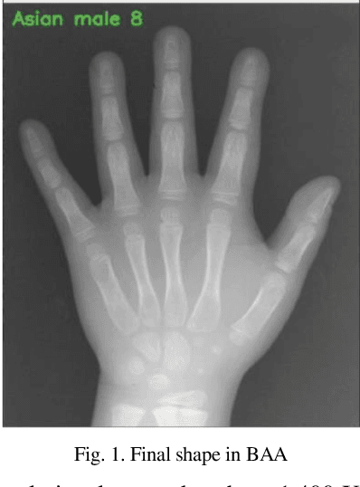 Figure 1 for Bone Age Estimation by Deep Learning in X-Ray Medical Images