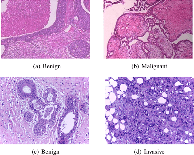 Figure 1 for Breast Cancer Histopathology Image Classification and Localization using Multiple Instance Learning