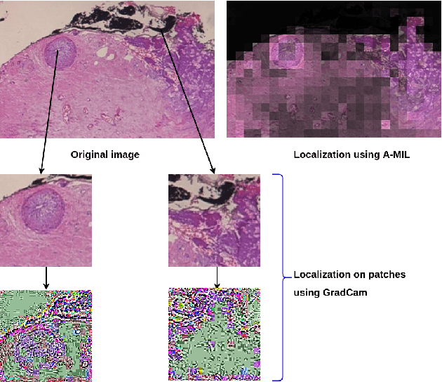 Figure 3 for Breast Cancer Histopathology Image Classification and Localization using Multiple Instance Learning