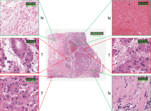 Figure 1 for A deep learning based multiscale approach to segment cancer area in liver whole slide image