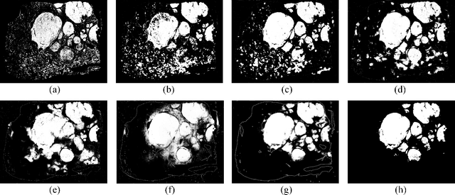 Figure 3 for A deep learning based multiscale approach to segment cancer area in liver whole slide image