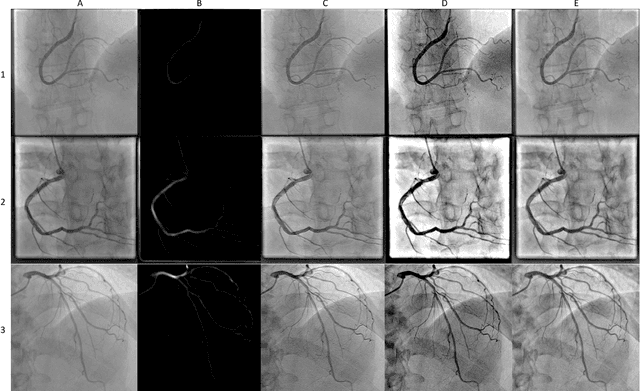 Figure 1 for A Review of Modern Approaches for Coronary Angiography Imaging Analysis