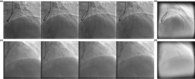 Figure 1 for Robust Landmark-based Stent Tracking in X-ray Fluoroscopy
