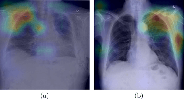 Figure 3 for Dynamic Routing on Deep Neural Network for Thoracic Disease Classification and Sensitive Area Localization