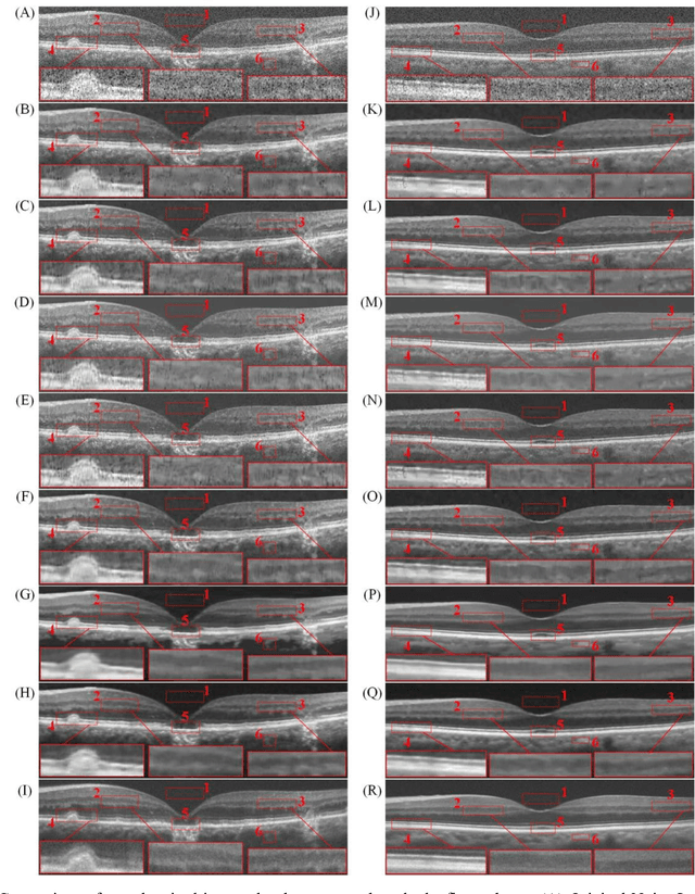 Figure 3 for Three-dimensional Optical Coherence Tomography Image Denoising via Multi-input Fully-Convolutional Networks