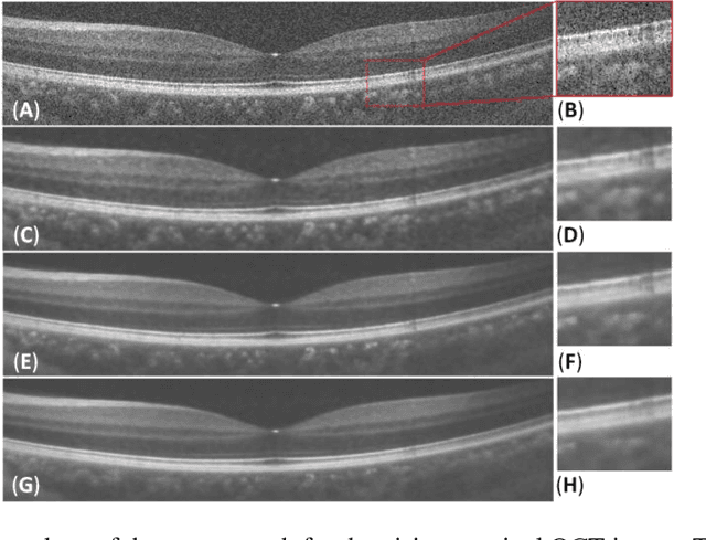 Figure 4 for Three-dimensional Optical Coherence Tomography Image Denoising via Multi-input Fully-Convolutional Networks