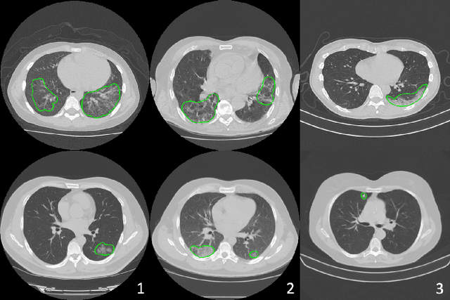 Figure 3 for Federated Semi-Supervised Learning for COVID Region Segmentation in Chest CT using Multi-National Data from China, Italy, Japan