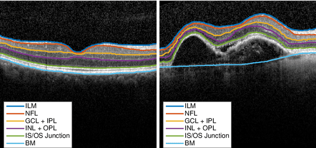 Figure 1 for Pathological OCT Retinal Layer Segmentation using Branch Residual U-shape Networks