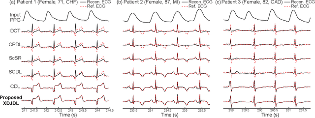 Figure 2 for Cross-domain Joint Dictionary Learning for ECG Inference from PPG
