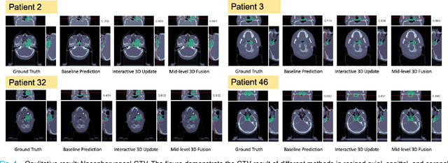 Figure 4 for Interactive Radiotherapy Target Delineation with 3D-Fused Context Propagation