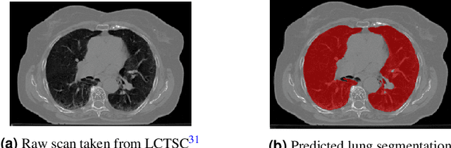 Figure 3 for Using Deep Learning-based Features Extracted from CT scans to Predict Outcomes in COVID-19 Patients