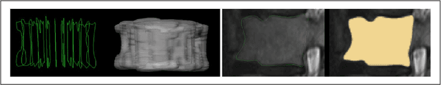 Figure 1 for Vertebral body segmentation with GrowCut: Initial experience, workflow and practical application