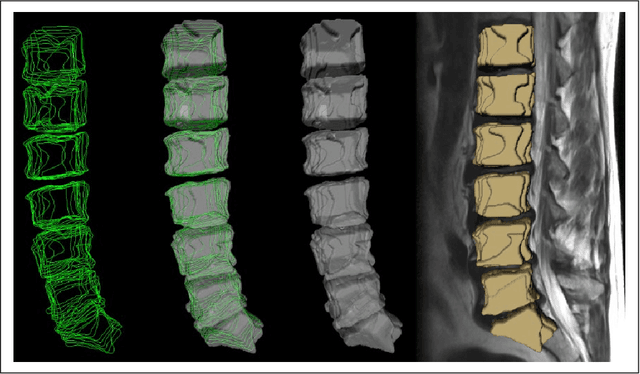 Figure 3 for Vertebral body segmentation with GrowCut: Initial experience, workflow and practical application