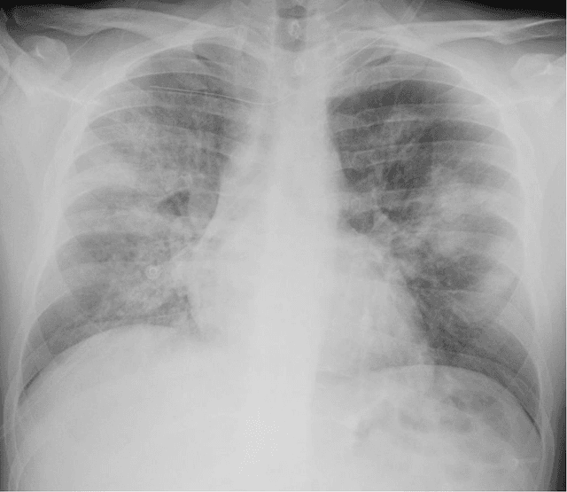 Figure 1 for Automatic classification between COVID-19 pneumonia, non-COVID-19 pneumonia, and the healthy on chest X-ray image: combination of data augmentation methods in a small dataset