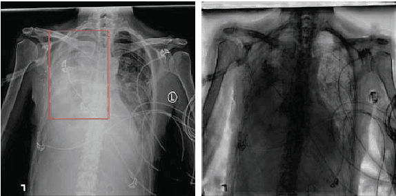 Figure 2 for Context Learning for Bone Shadow Exclusion in CheXNet Accuracy Improvement