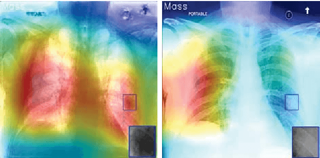 Figure 4 for Context Learning for Bone Shadow Exclusion in CheXNet Accuracy Improvement