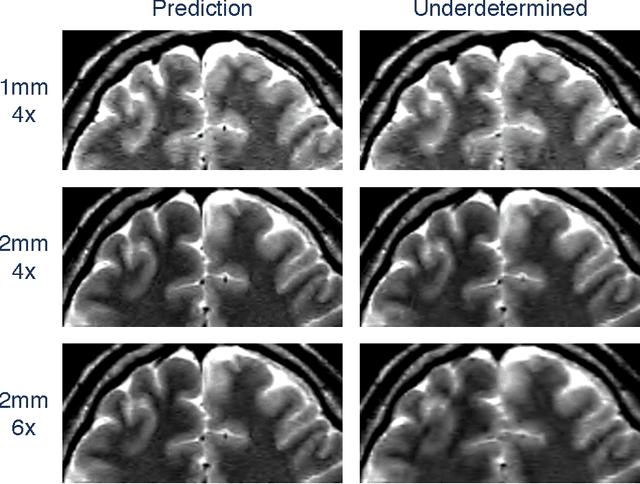 Figure 2 for On the Empirical Effect of Gaussian Noise in Under-sampled MRI Reconstruction