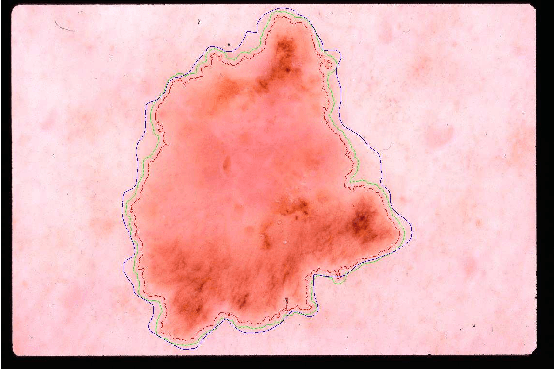 Figure 3 for Lesion Border Detection in Dermoscopy Images Using Ensembles of Thresholding Methods