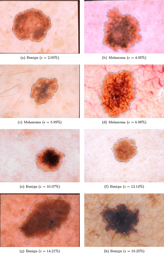 Figure 4 for Lesion Border Detection in Dermoscopy Images Using Ensembles of Thresholding Methods