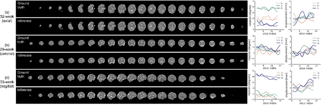 Figure 4 for AFFIRM: Affinity Fusion-based Framework for Iteratively Random Motion correction of multi-slice fetal brain MRI