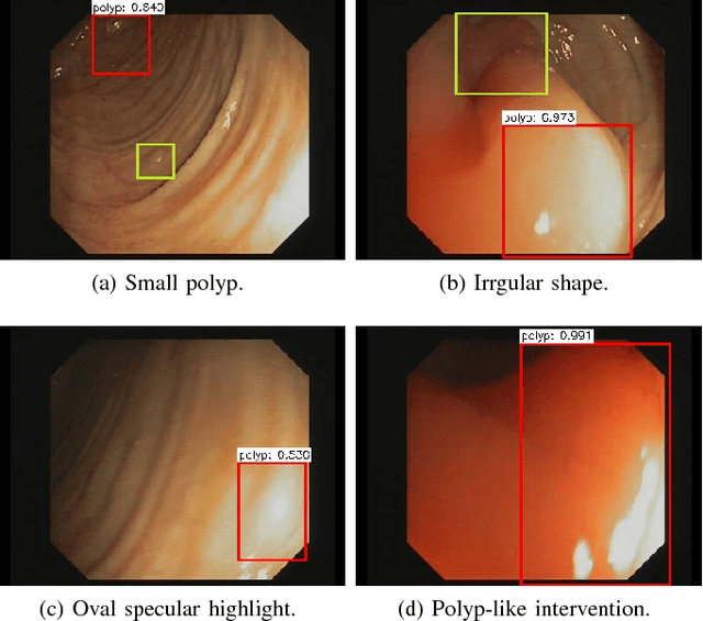 Figure 3 for An Efficient Approach for Polyps Detection in Endoscopic Videos Based on Faster R-CNN