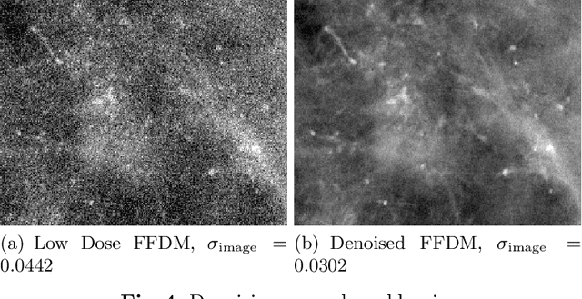 Figure 3 for Deep Learning-based Denoising of Mammographic Images using Physics-driven Data Augmentation