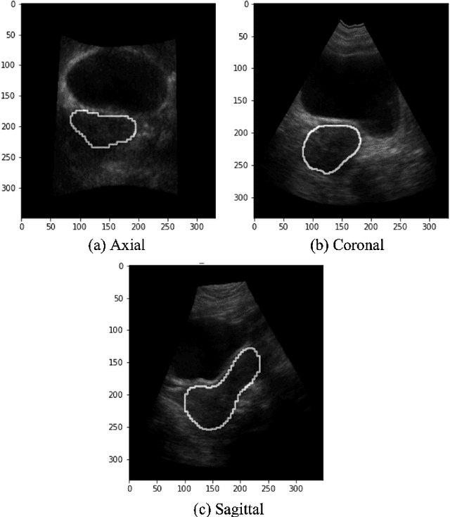 Figure 2 for Automatic 3D Ultrasound Segmentation of Uterus Using Deep Learning