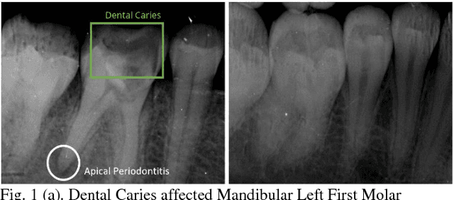 Figure 1 for Image Processing on IOPA Radiographs: A comprehensive case study on Apical Periodontitis