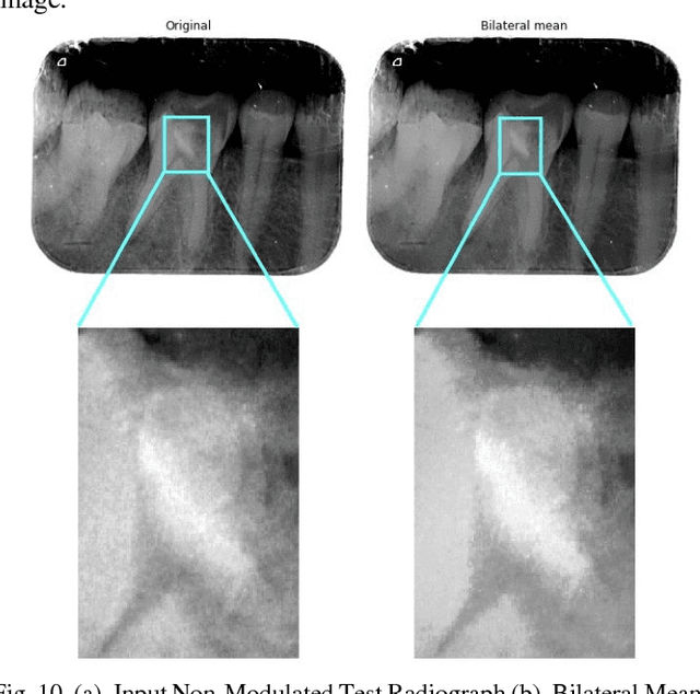 Figure 2 for Image Processing on IOPA Radiographs: A comprehensive case study on Apical Periodontitis