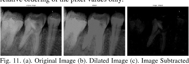 Figure 3 for Image Processing on IOPA Radiographs: A comprehensive case study on Apical Periodontitis