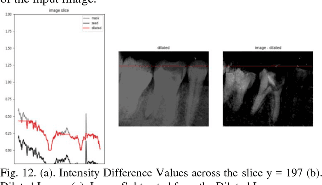 Figure 4 for Image Processing on IOPA Radiographs: A comprehensive case study on Apical Periodontitis
