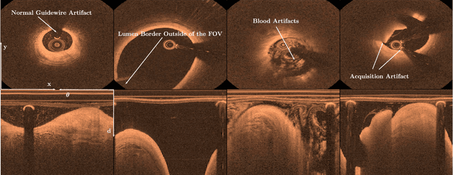 Figure 1 for Automatic Plaque Detection in IVOCT Pullbacks Using Convolutional Neural Networks