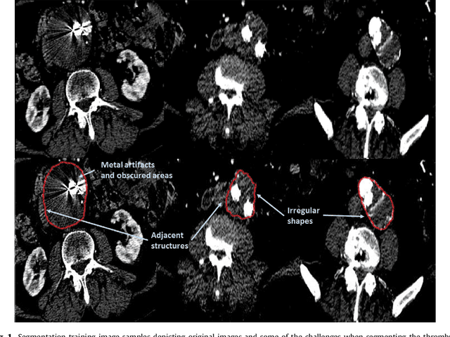 Figure 1 for Fully automatic detection and segmentation of abdominal aortic thrombus in post-operative CTA images using deep convolutional neural networks