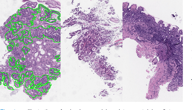 Figure 1 for Mixed Supervision Learning for Whole Slide Image Classification