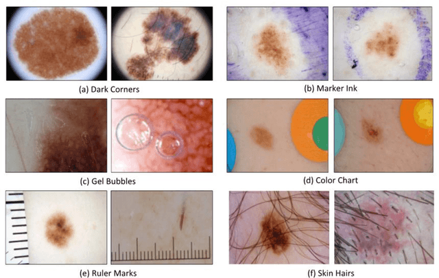 Figure 2 for An Overview of Melanoma Detection in Dermoscopy Images Using Image Processing and Machine Learning