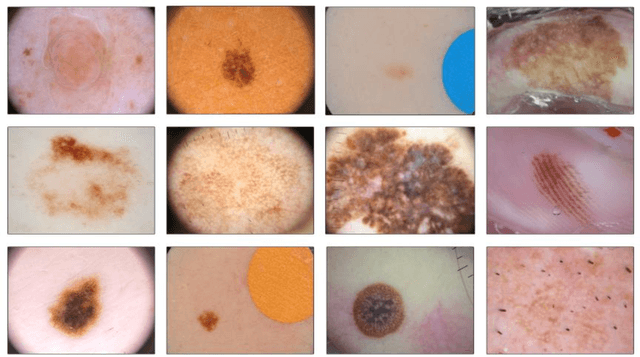 Figure 3 for An Overview of Melanoma Detection in Dermoscopy Images Using Image Processing and Machine Learning