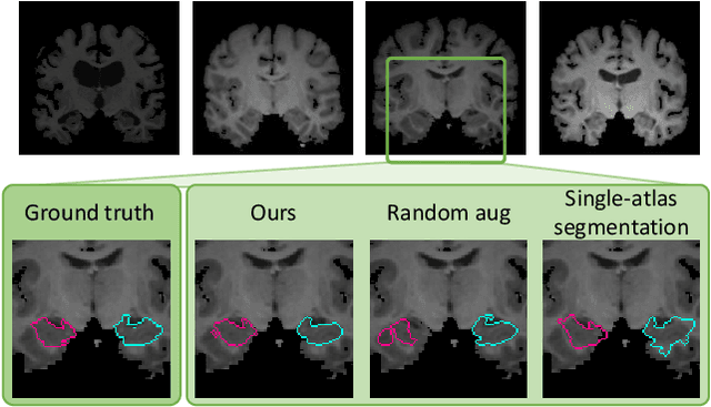 Figure 1 for Data augmentation using learned transformations for one-shot medical image segmentation