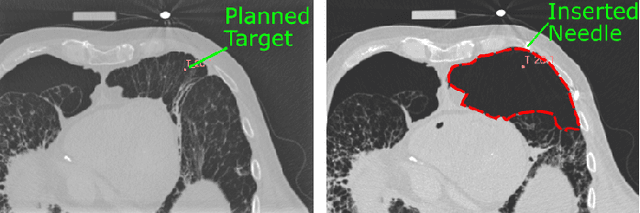 Figure 3 for Robotic Tissue Sampling for Safe Post-mortem Biopsy in Infectious Corpses