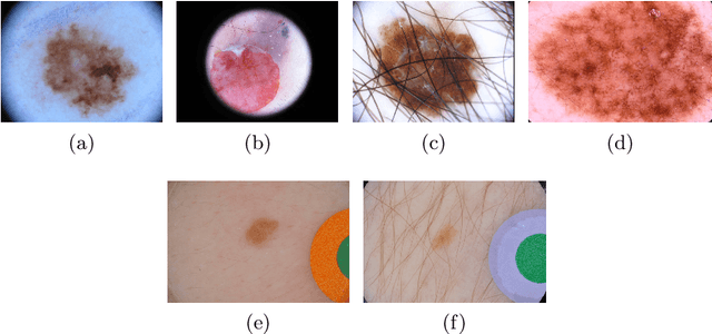 Figure 3 for Using Spatial Logic and Model Checking for Nevus Segmentation
