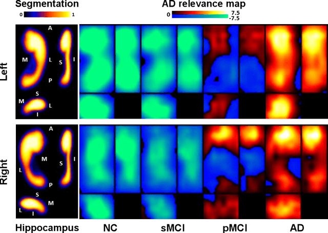 Figure 3 for A deep learning model for early prediction of Alzheimer's disease dementia based on hippocampal MRI