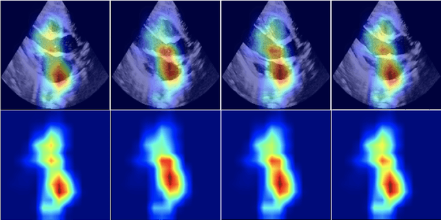 Figure 4 for Interpretable Prediction of Pulmonary Hypertension in Newborns using Echocardiograms