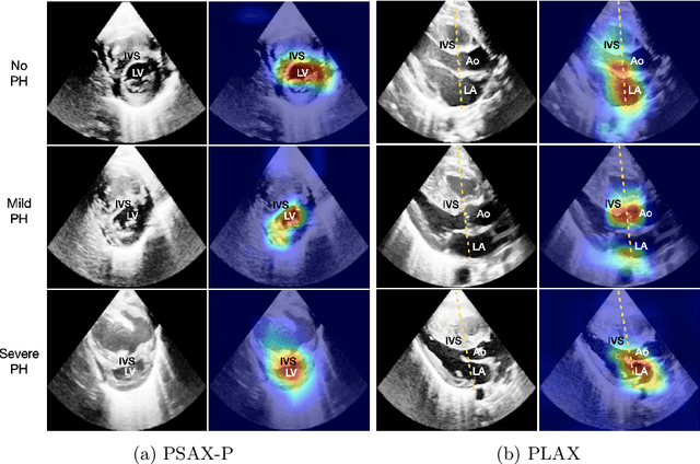 Figure 2 for Interpretable Prediction of Pulmonary Hypertension in Newborns using Echocardiograms
